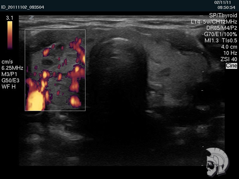 Аутоиммунный тиреоидит